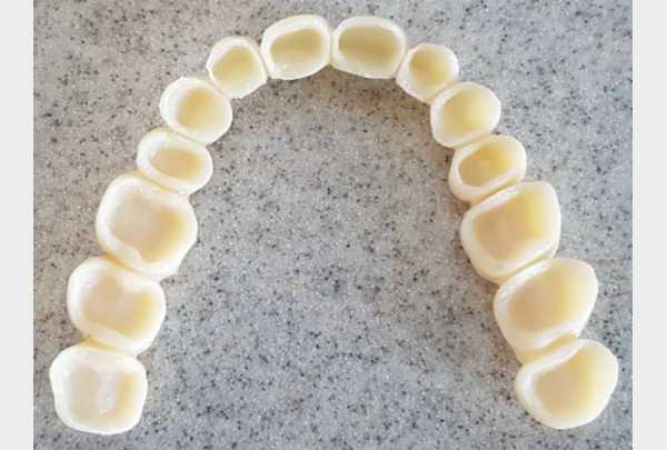 Temporary crowns.jpg