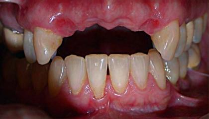 Gum transplant before