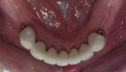 Partial denture with precision attachments during