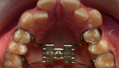 Braces during1