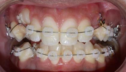 Glass brackets during