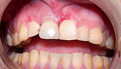 Apisectomy procedure to remove abcess