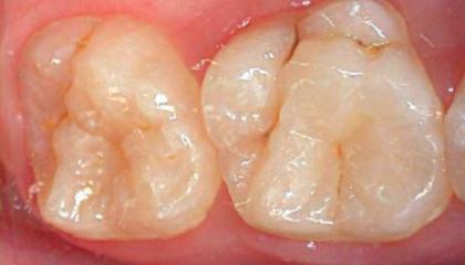 Fissure sealants1
