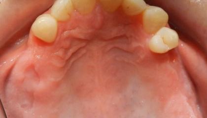 Before implants and veneers