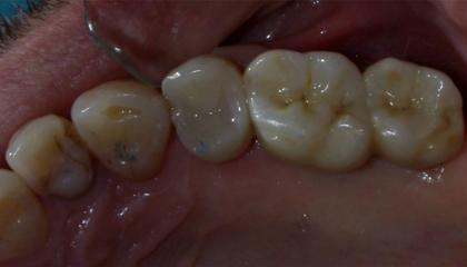 Short implants avoiding sinus lift after