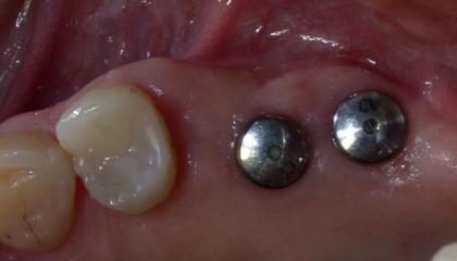 Short implants avoiding sinus lift