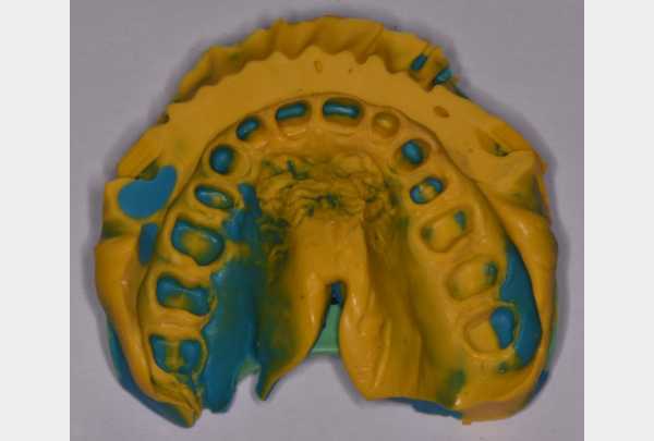 Silicone impression.jpg