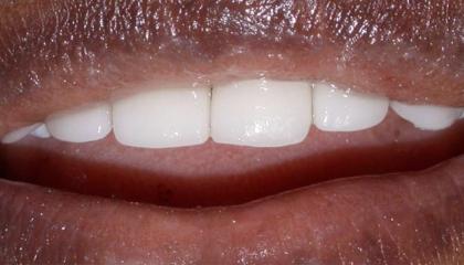 Resin veneers4