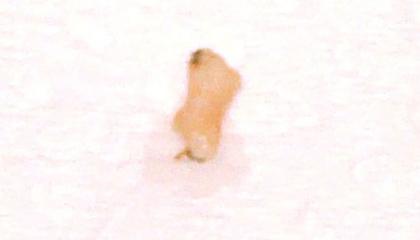 surgery salivaduct_stone1