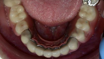 Partial denture with precision attachments after
