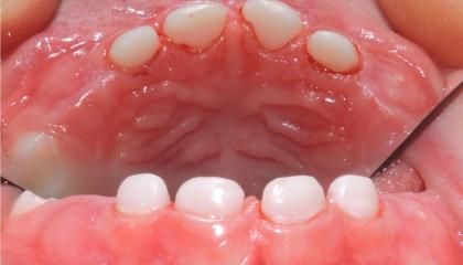 Direct resin crowns