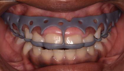 3D printed stent for gum contouring