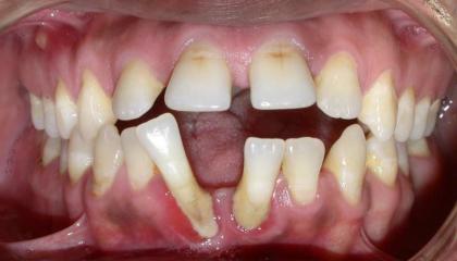 Adult braces before
