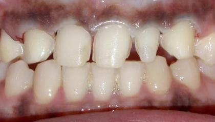 Resin veneers3