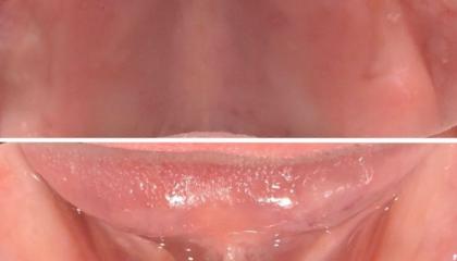 Edentulous dental ridges