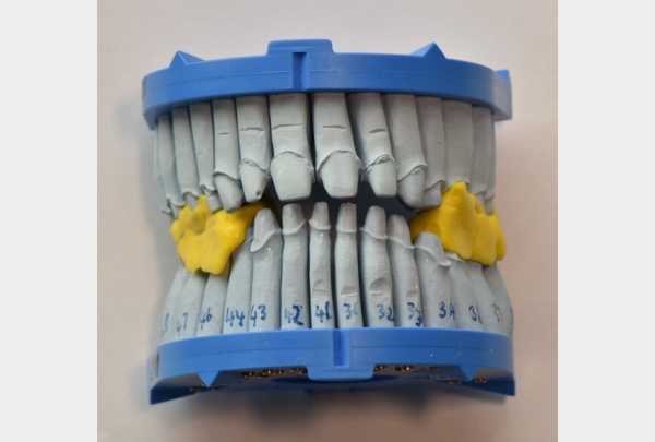 Plaster models with silicone bite.jpg