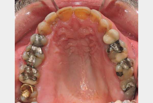 Upper arch before treatment.jpg