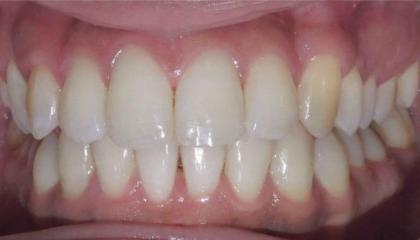 Glass brackets after