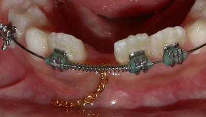 Interceptive braces during