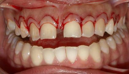 Crown lengthening procedure