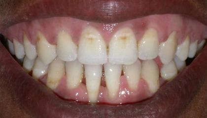 Adult braces after1