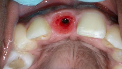 Replace front tooth with bone level implant