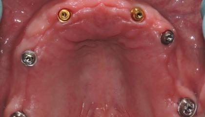 Implants ready for impressions