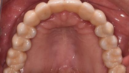 Upper arch after