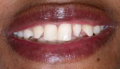 Resin veneers1