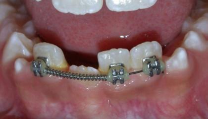 Interceptive braces after