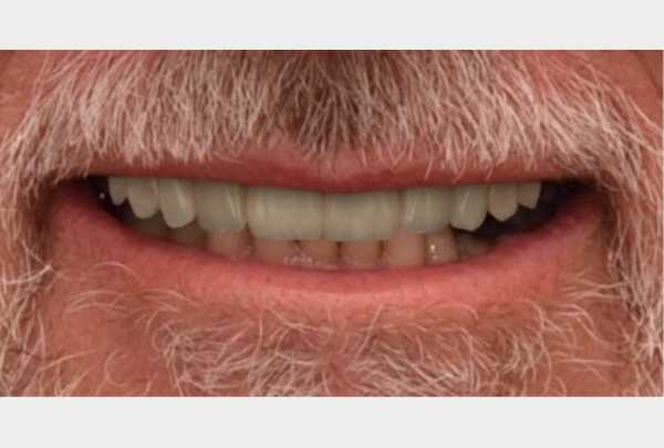 Simulation before treatment.jpg