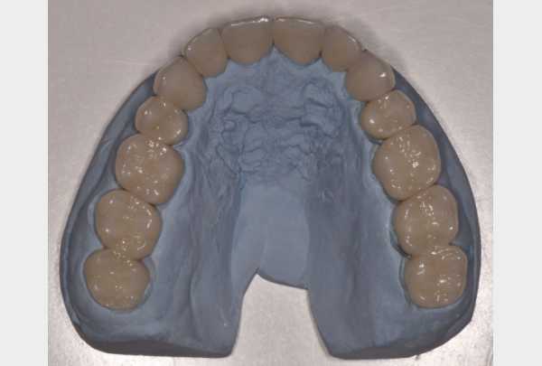 Zirconia crowns on model.jpg