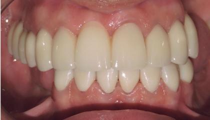 Zirconia crowns and bridge
