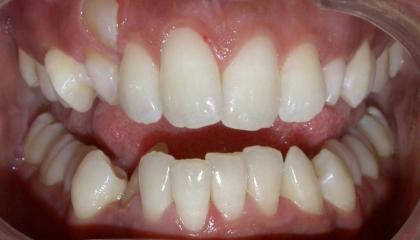 Glass brackets before