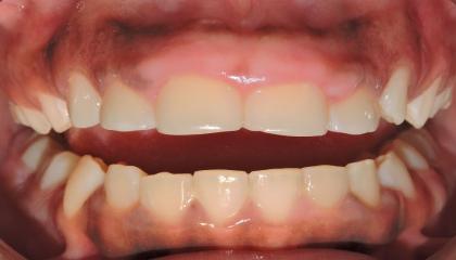 Before   Excessive gum (2).JPG