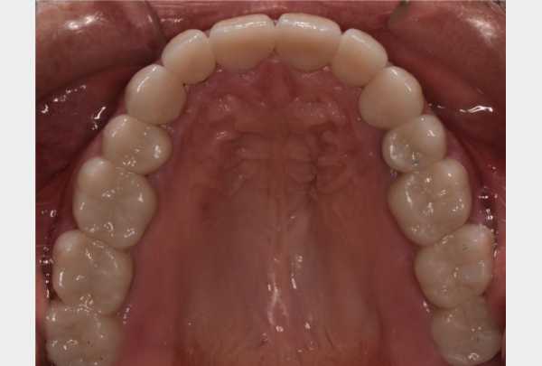 Upper arch after treatment with zirconia crowns in place.jpg