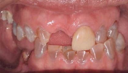 Missing front tooth and worn discoloured teeth