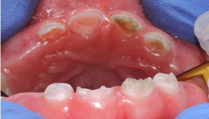 Baby bottle tooth decay