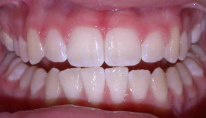 Frenulum removal after