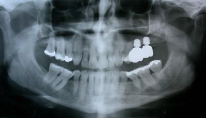 Short implants avoiding sinus lift after X ray