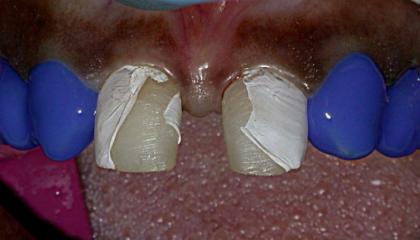 Closure of the gap and changing the canine teeth to laterals during